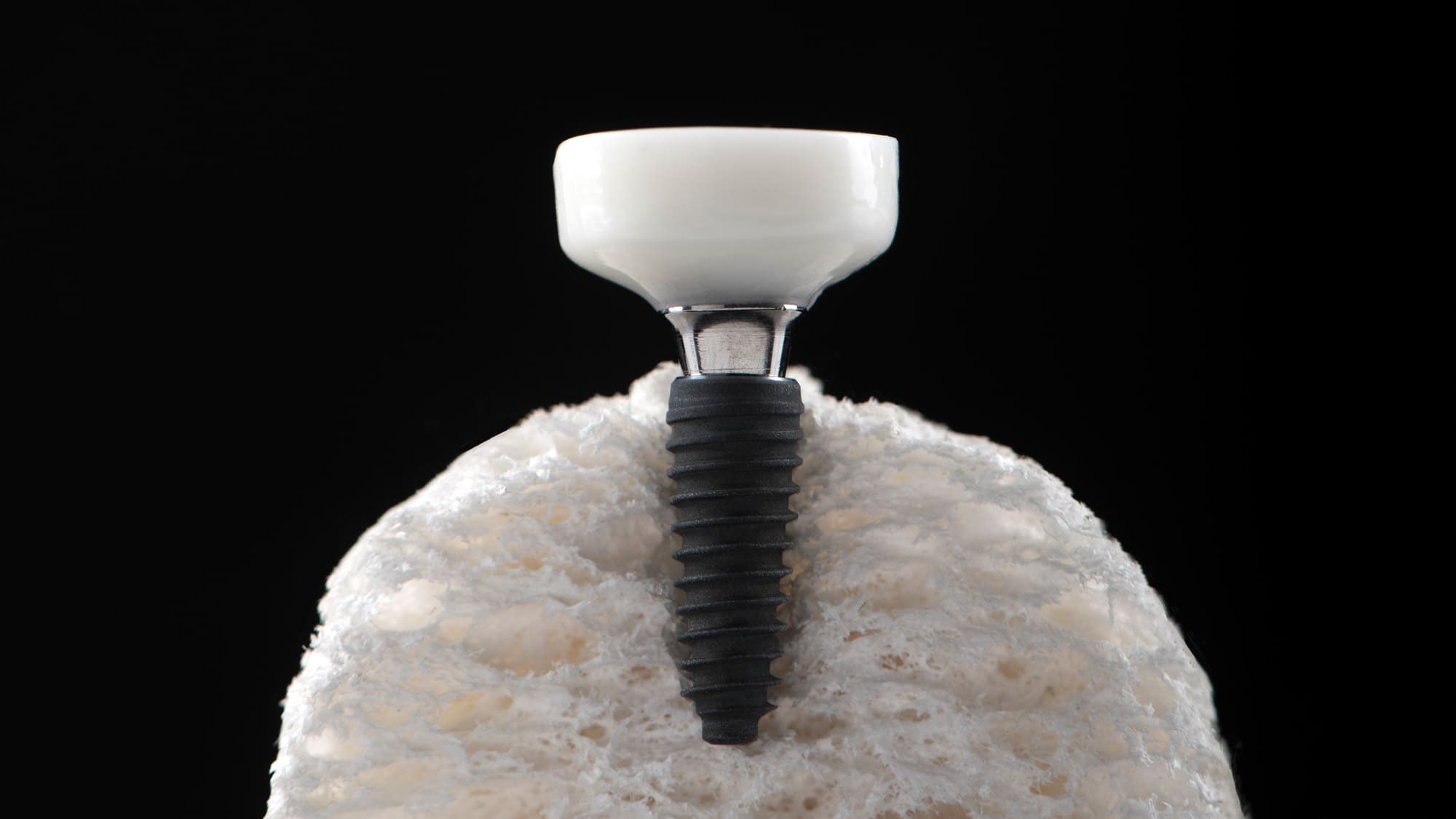 A custom anatomical healing abutment on an implant, seated in bone