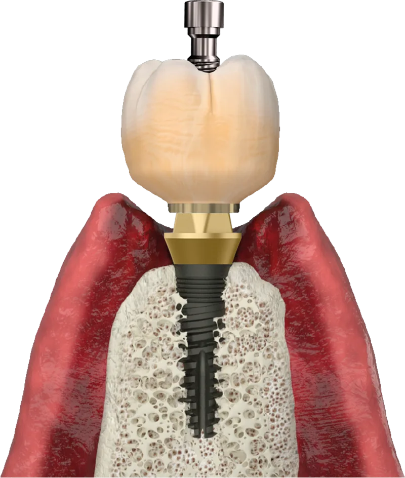 Deliver the prosthesis